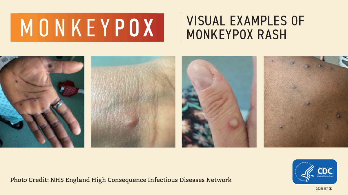 Monkey Pox Visuals